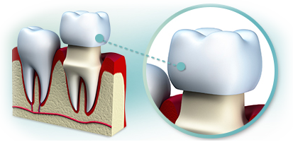 Explicação de coroa dentária