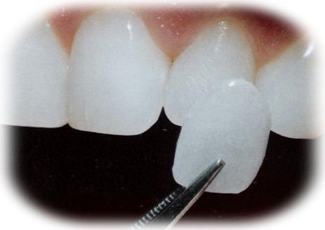 Explicaçao de faceta dentária